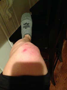 That is not my knee cap you see. 